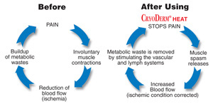 CyroDerm Pain Spasm Cycle Image
