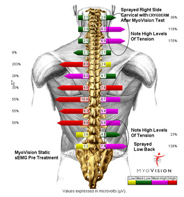  Pre Treatment MyoVision Exam Spine Image