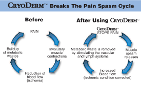 CyroDerm Pain Spasm Cycle Image